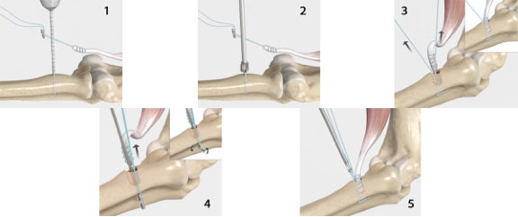 biceps tendon repair